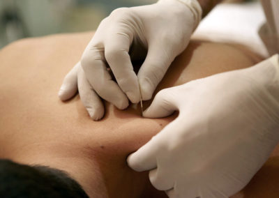 Dry Needling – Niveau 1